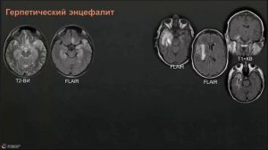 Нейроинфекции