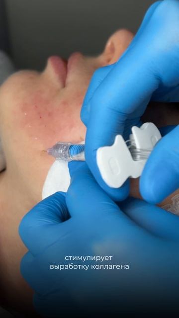 Что делать при появлении первых признаков морщин?