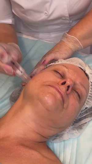 Микроигольчатый коктейль для преображения кожи DEEP SOOT AA (Dermatime, Испания). Метод применения.