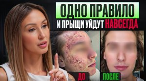 СЕКРЕТ ИДЕАЛЬНОЙ КОЖИ от дерматолога: ЧТО ПИТЬ от прыщей, постакне и пигментации. Главные ошибки!