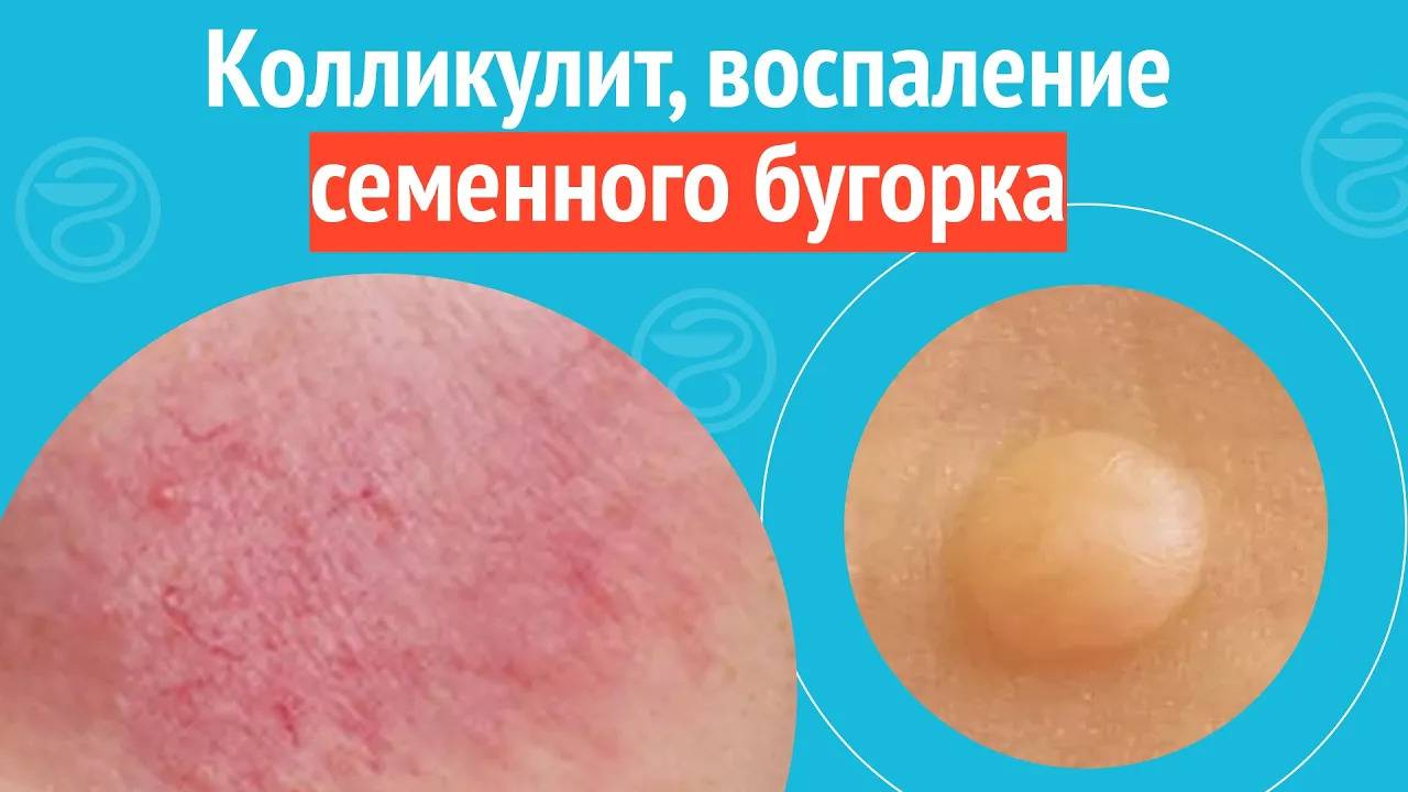 😨 Колликулит, воспаление семенного бугорка. Клинический случай №1666