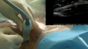 Анестезия сплетения