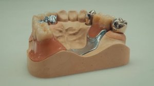 Съемные протезы с фиксацией на телескопические и двойные коронки