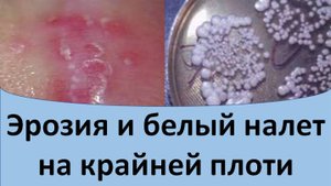 Эрозия и белый налет на крайней плоти