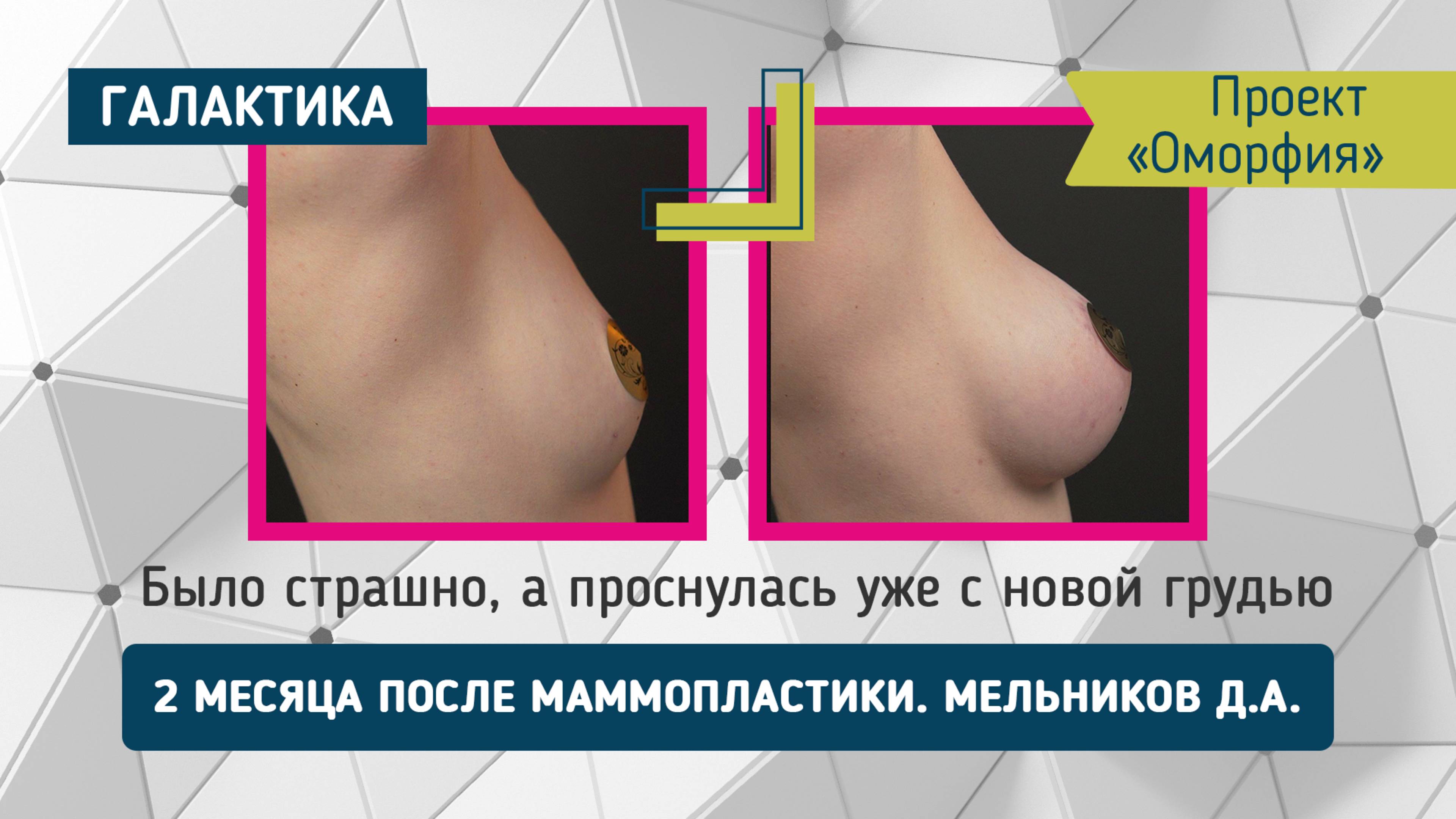 Оморфия 