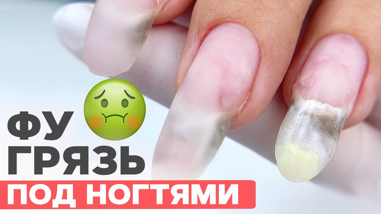 Грязь под ногтями после ОГОРОДА | Коррекция и поднятие клюющих ногтей смотреть онлайн