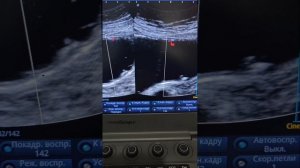 Полип желудка на УЗИ