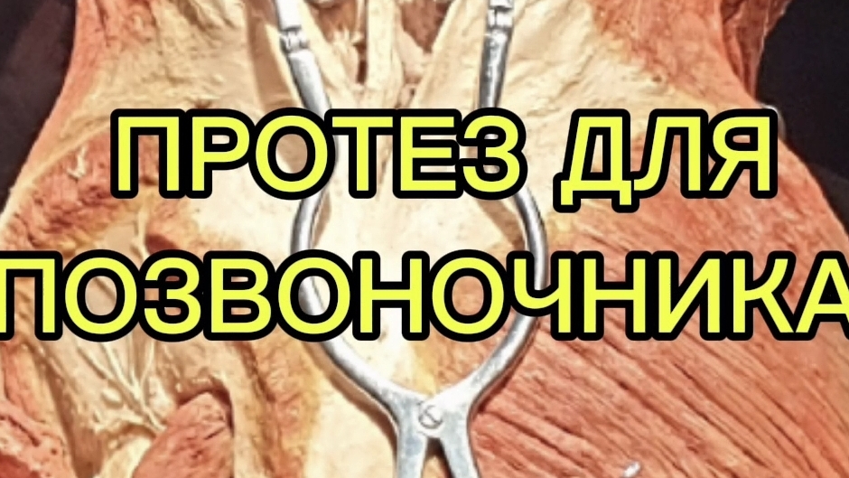 ПРОТЕЗ ДЛЯ ПОЗВОНОЧНИКА