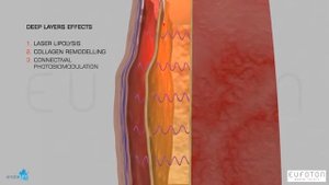 Endolift® Animation