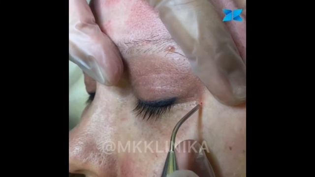 Лазерная блефаропластика. ППИЭ
