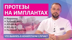 Протезы на имплантах - зубные коронки, зубной мост, полный протез, all-on-4, all-on-6