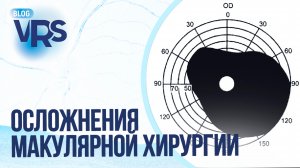 Осложнения макулярной хирургии