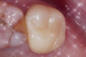 Моляр Фрактура Перелечка