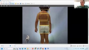 Врожденные сколиозы и сколиозы до 7 лет