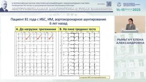 ЭКГ-нагрузочные тесты, как ключевой метод диагностики в выборе лечения желудочковых аритмий при ИБС