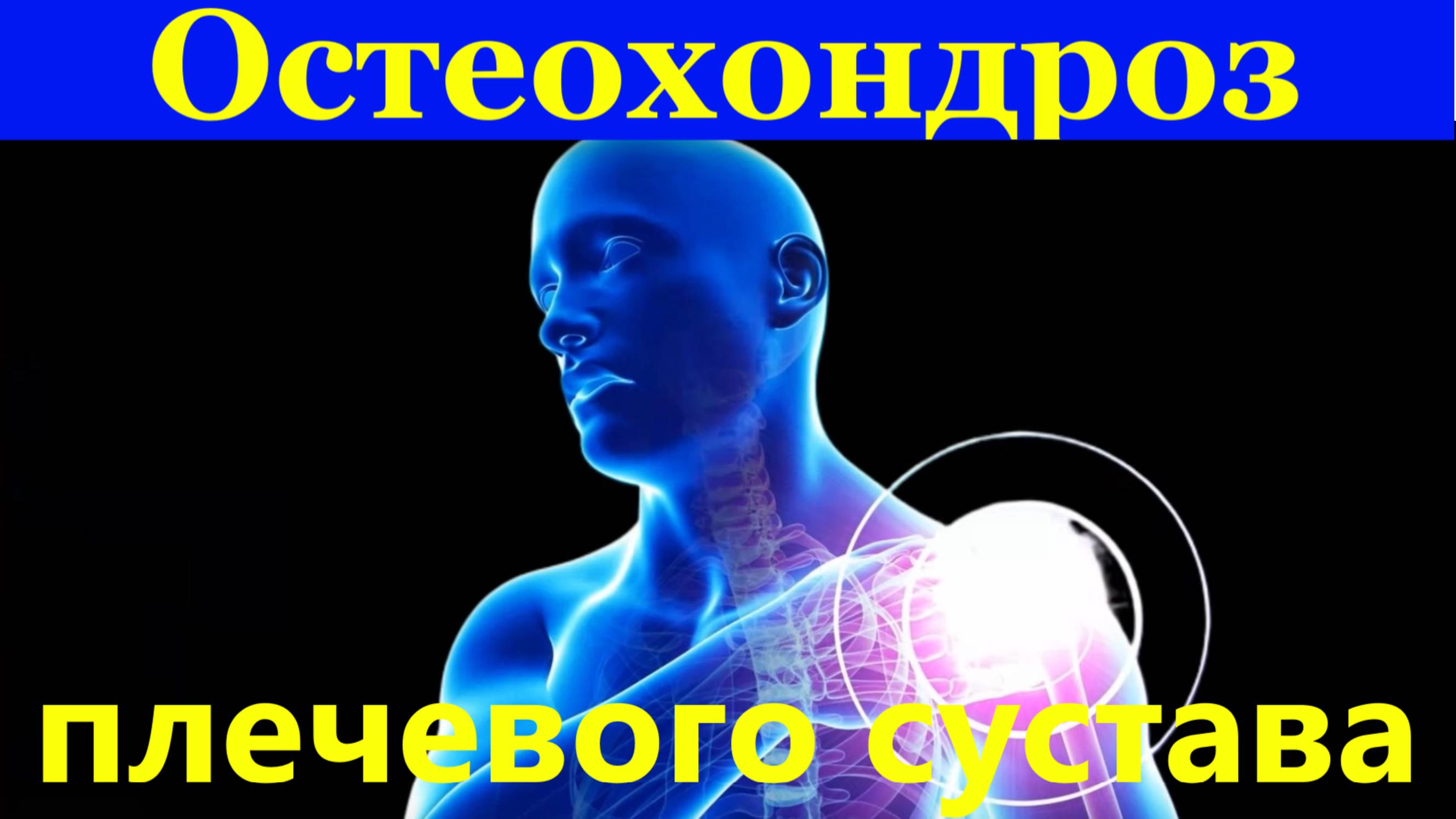 Остеохондроз плечевого сустава