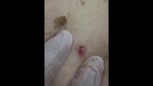 Удаление травмированного новообразования