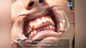 Как выглядит прикус при ротовом дыхании