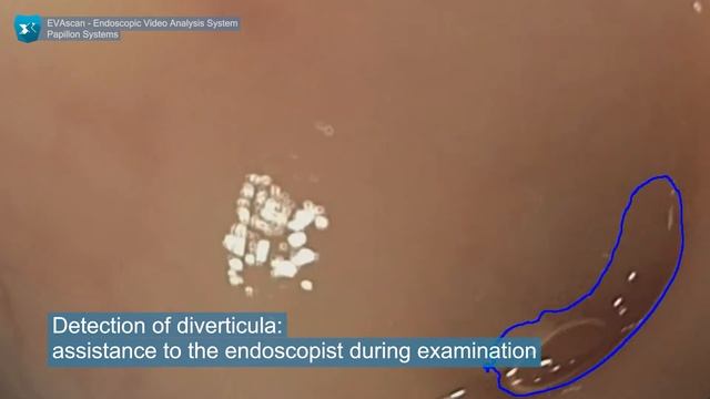 EVAscan Endoscopic Video Analysis System смотреть онлайн