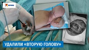 Хирурги из Кирова удалили пациенту липому размером с голову