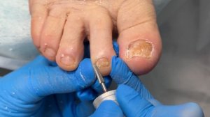 КАК ПРОСТО ПОБЕДИТЬ ГРИБОК НОГТЕЙ