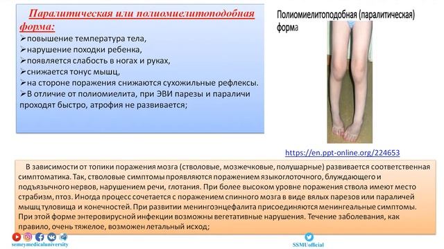 Энтеровирусная инфекция