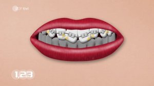 Как_работают_фиксированные_брекеты