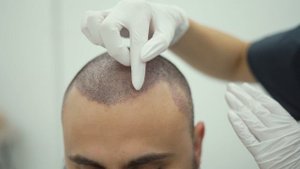 Пересадка волос в клинике InnovaLine