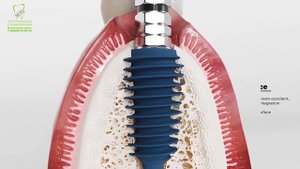 Имплантация Aniridge в мягкой, пористойкости после удаления зуба.mp4