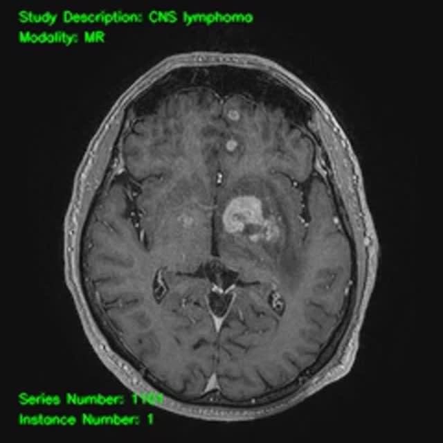 Dagomarus^Brain^CNS_tumor (lymphoma)
