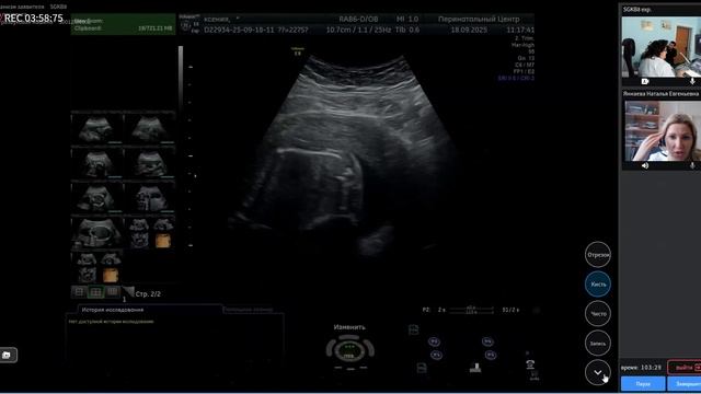 УЗИ. Беременность. Чехонацкая М.Л., Янаева Н.Е. Синдром Денди-Уокера