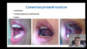 Хроническая Реакция «трансплантат против хозяина» (РТПХ)