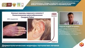 Парусов Андрей Игоревич Дерматологические маркеры патологии печени