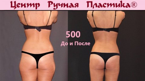 Ручная пластика тела Центр Ручная Пластика. Ручная липосакция. ruchnaya-plastika.ru