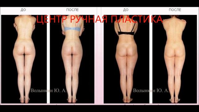 Центр Ручная Пластика. Ручная пластика тела. 500 фото До и После. ruchnaya-plastika.ru