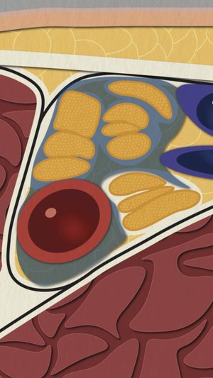 Подмышечная блокада под УЗИ | Техника 4 нервов: как найти "беглеца"?