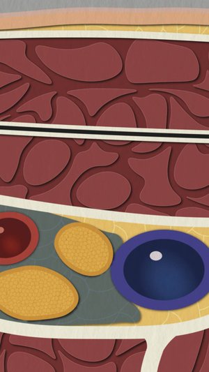 Подключичная блокада плечевого сплетения под УЗИ