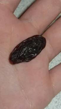 Как избавиться от папиллом _ народные методы