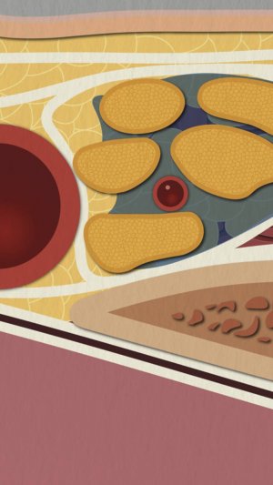 Надключичная блокада ("Спинальная анестезия руки") под УЗИ | Техника "Corner Pocket"