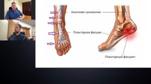Тендинопатия! Проблема суставов - как избавиться от боли?