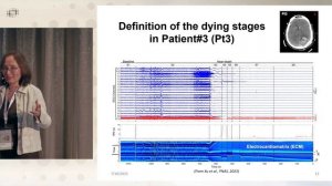 Джимо Борджигин. Возможные нейронные признаки околосмертного переживания у людей