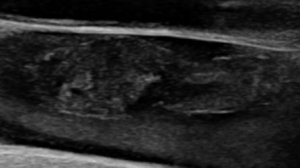 Неокклюзивный флотирующий тромбоз бедренной вены (УЗИ)