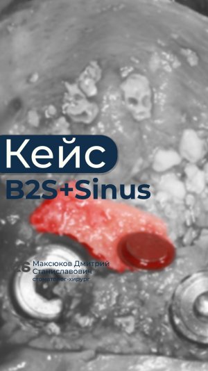 Синус-лифтинг+B2S