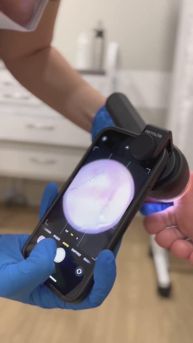 Криодеструкция бородавки в детской клинике Фэнтези