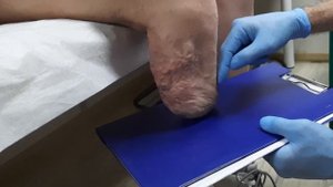 Замер объема культи голени для подбора силиконового чехла