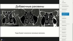 Лучевая Анатомия придаточных пазух носа 1