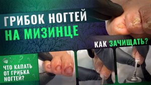 Грибок ногтей