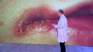 Врач рассказал, чего не хватает организму при образовании заед в уголках рта