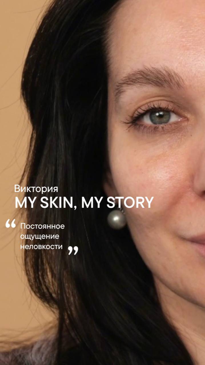 BABOR. MY SKIN, MY STORY: Виктория. Проблемная кожа, постакне, нарушенный барьер.