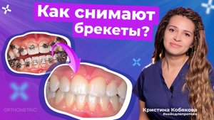 Сняли брекеты спустя год! Результат, который стоит увидеть